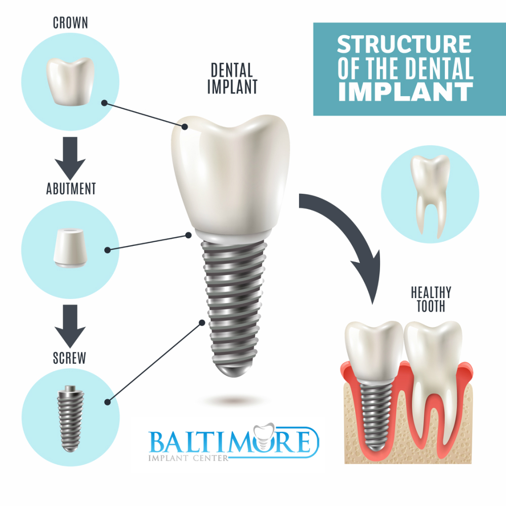 Baltimore Dental Implant » Atlanta Sod Suppliers